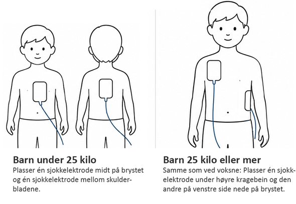 Elektrodeplassering på barn
