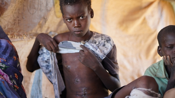 Ung gutt viser skadene i Sudan